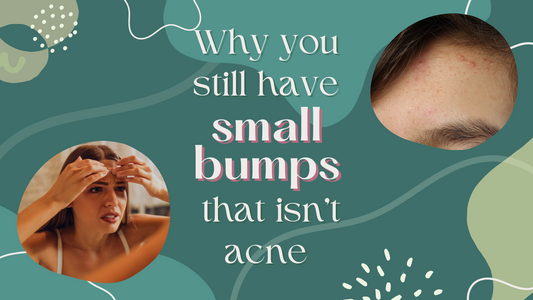blog feature image milia causes treament small bumps not acne